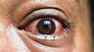 Read more about the article Conjunctivitis outbreak hits Mambwe 
