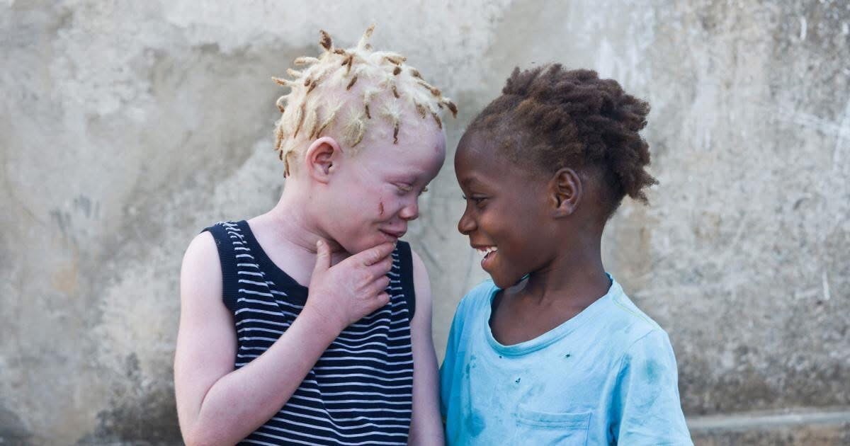 Read more about the article GOVT. CONCERNED ABOUT THE WELFARE OF PEOPLE WITH ALBINISM