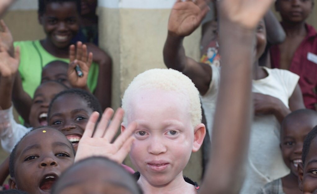 Read more about the article GOVT. CALLS FOR COLLABORATION IN PROTECTING PERSONS WITH ALBINISM